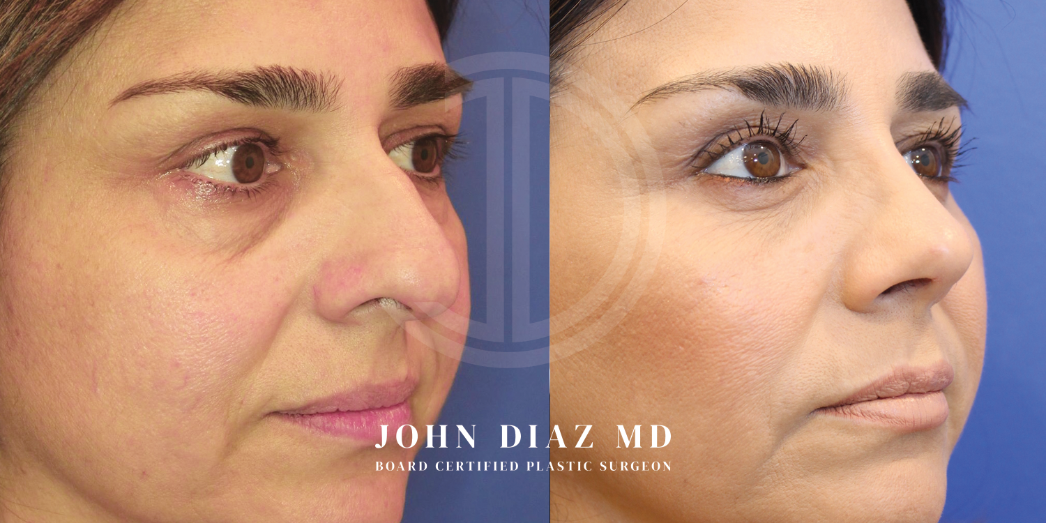 Dr John Diaz Before and After | Rhinoplasty