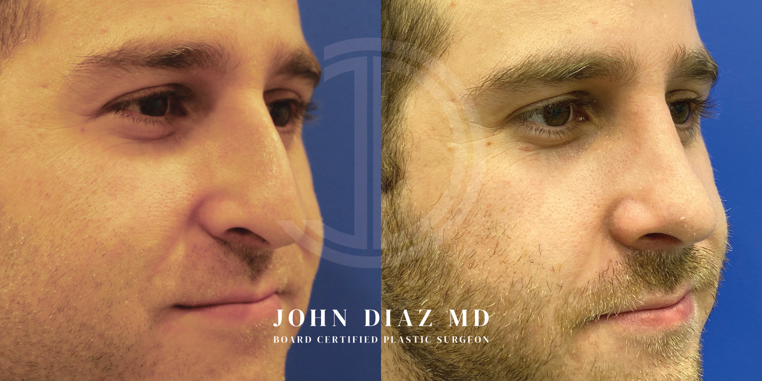 Dr John Diaz Before and After | Rhinoplasty