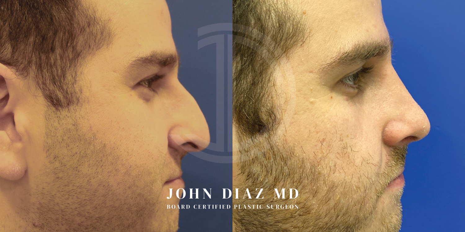 Dr John Diaz Before and After | Rhinoplasty