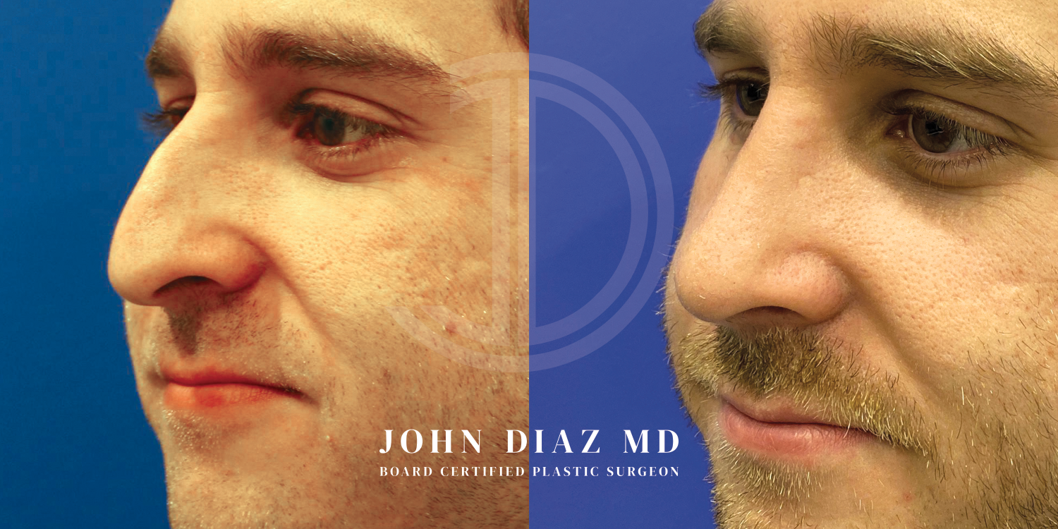 Dr John Diaz Before and After | Rhinoplasty