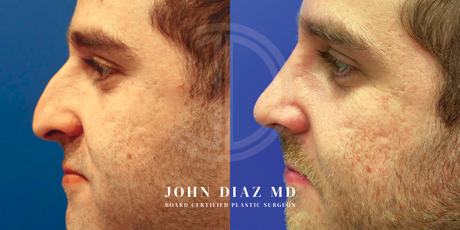 Dr John Diaz Before and After | Rhinoplasty