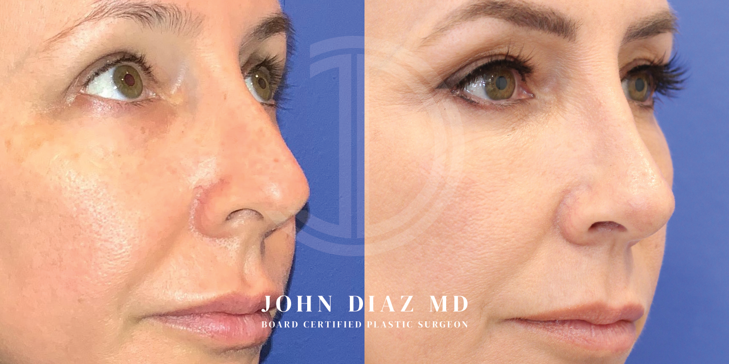 Dr John Diaz Before and After | Rhinoplasty