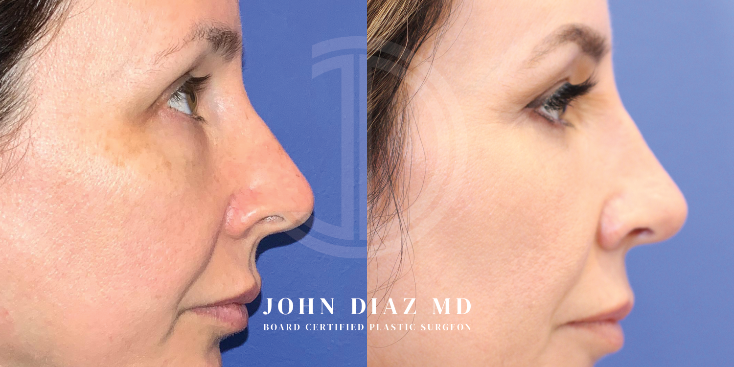 Dr John Diaz Before and After | Rhinoplasty