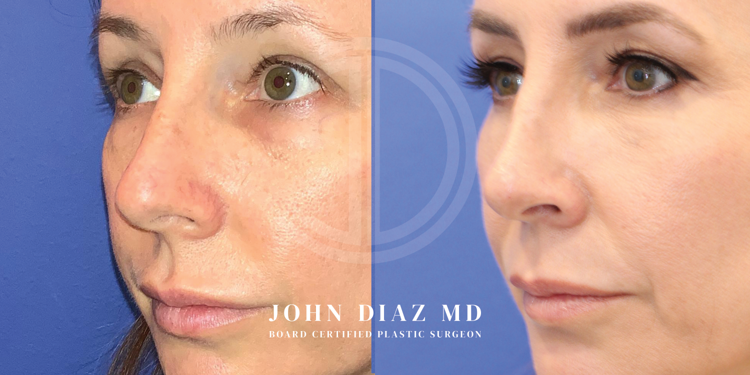 Dr John Diaz Before and After | Rhinoplasty