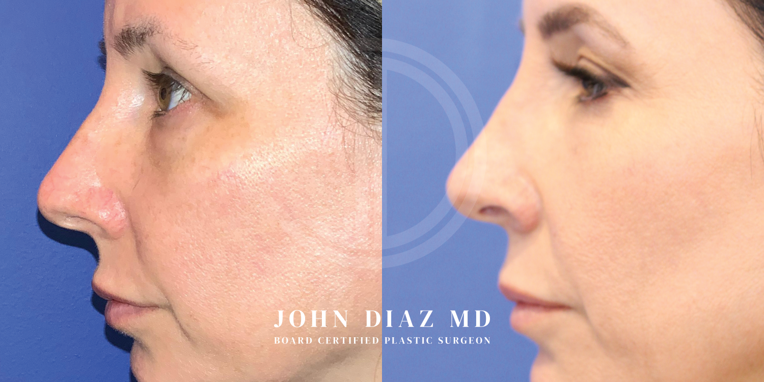 Dr John Diaz Before and After | Rhinoplasty