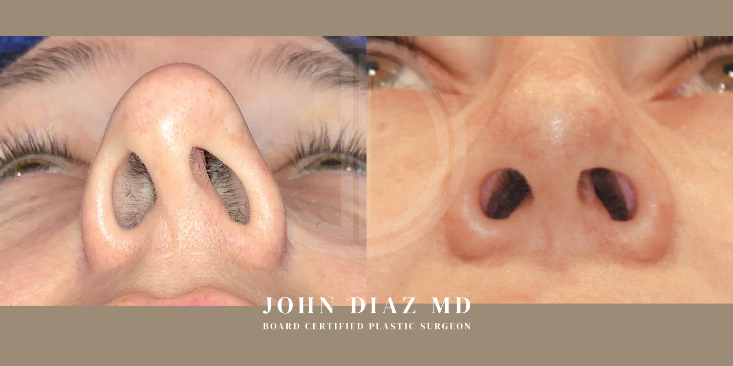 Dr John Diaz Before and After | Rhinoplasty