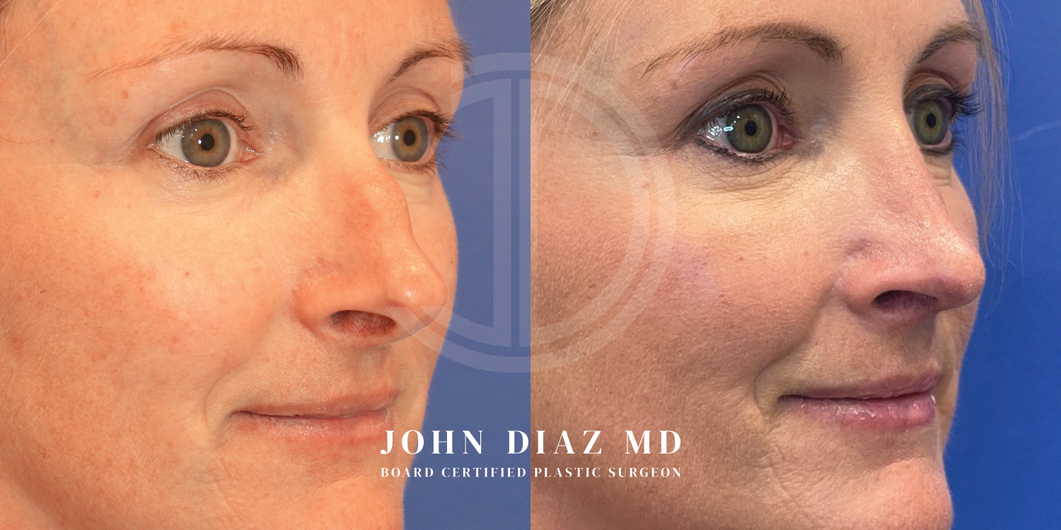 Dr John Diaz Before and After | Rhinoplasty