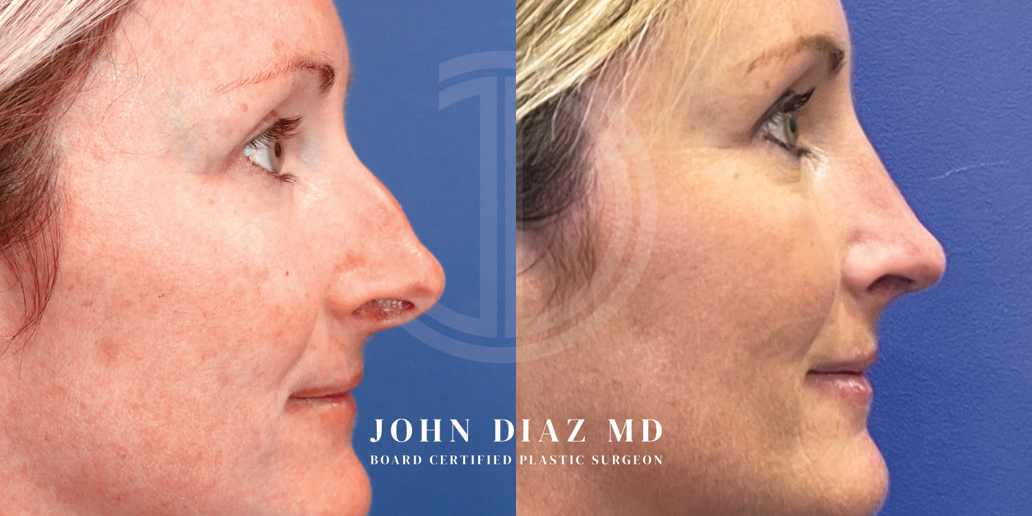 Dr John Diaz Before and After | Rhinoplasty