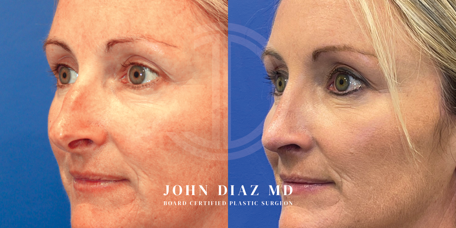 Dr John Diaz Before and After | Rhinoplasty