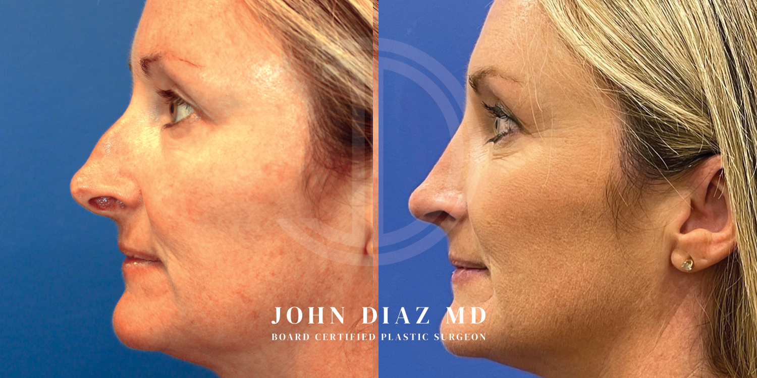 Dr John Diaz Before and After | Rhinoplasty