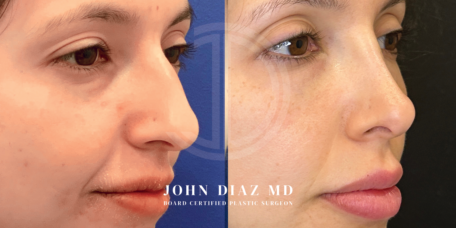 Dr John Diaz Before and After | Rhinoplasty
