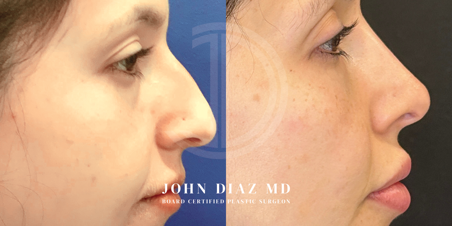 Dr John Diaz Before and After | Rhinoplasty