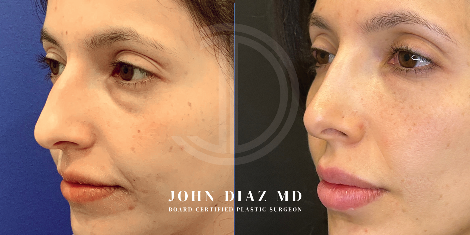 Dr John Diaz Before and After | Rhinoplasty