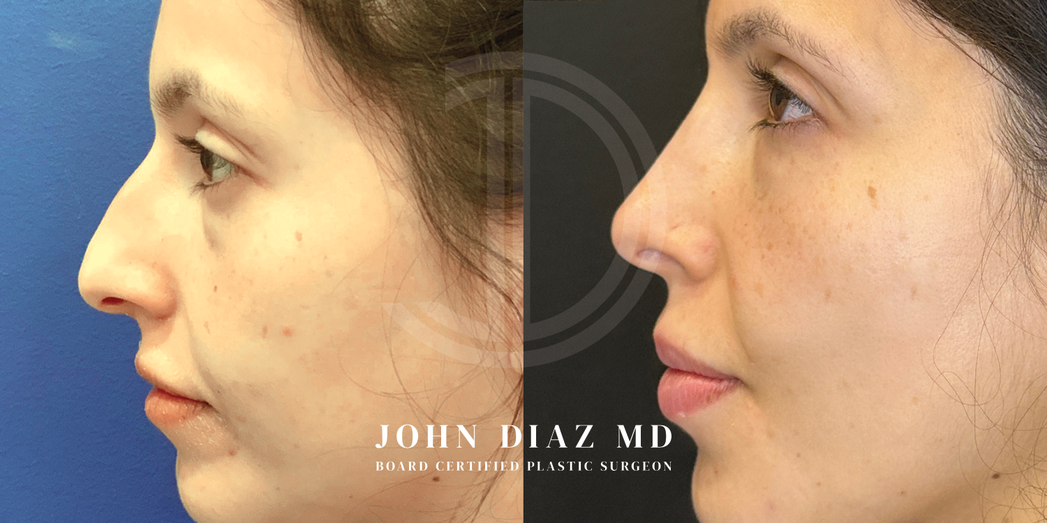 Dr John Diaz Before and After | Rhinoplasty