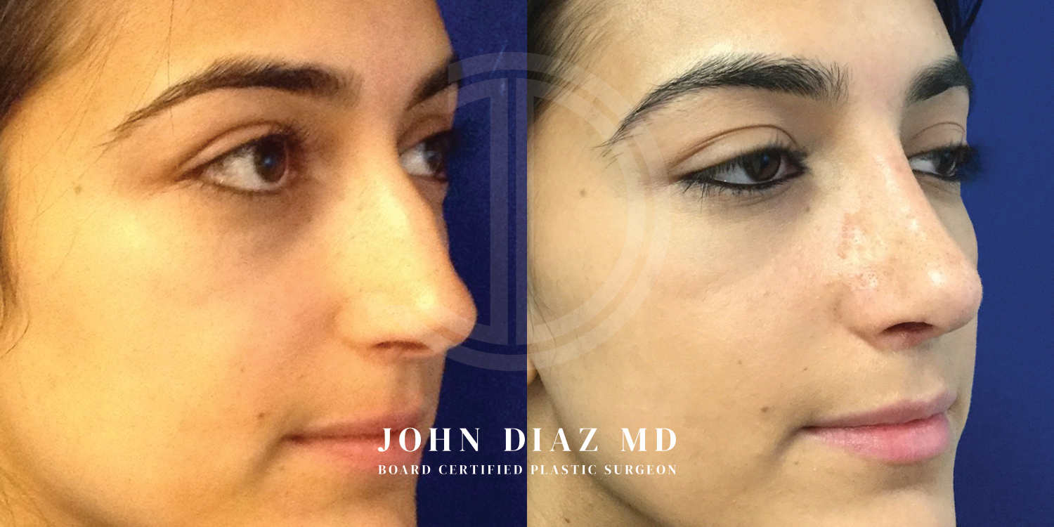 Dr John Diaz Before and After | Rhinoplasty