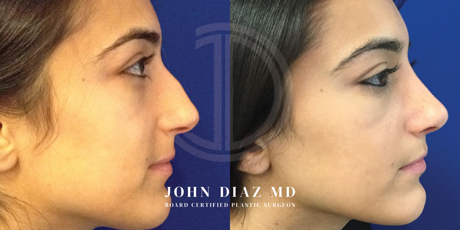 Dr John Diaz Before and After | Rhinoplasty