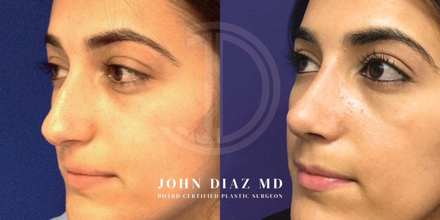 Dr John Diaz Before and After | Rhinoplasty