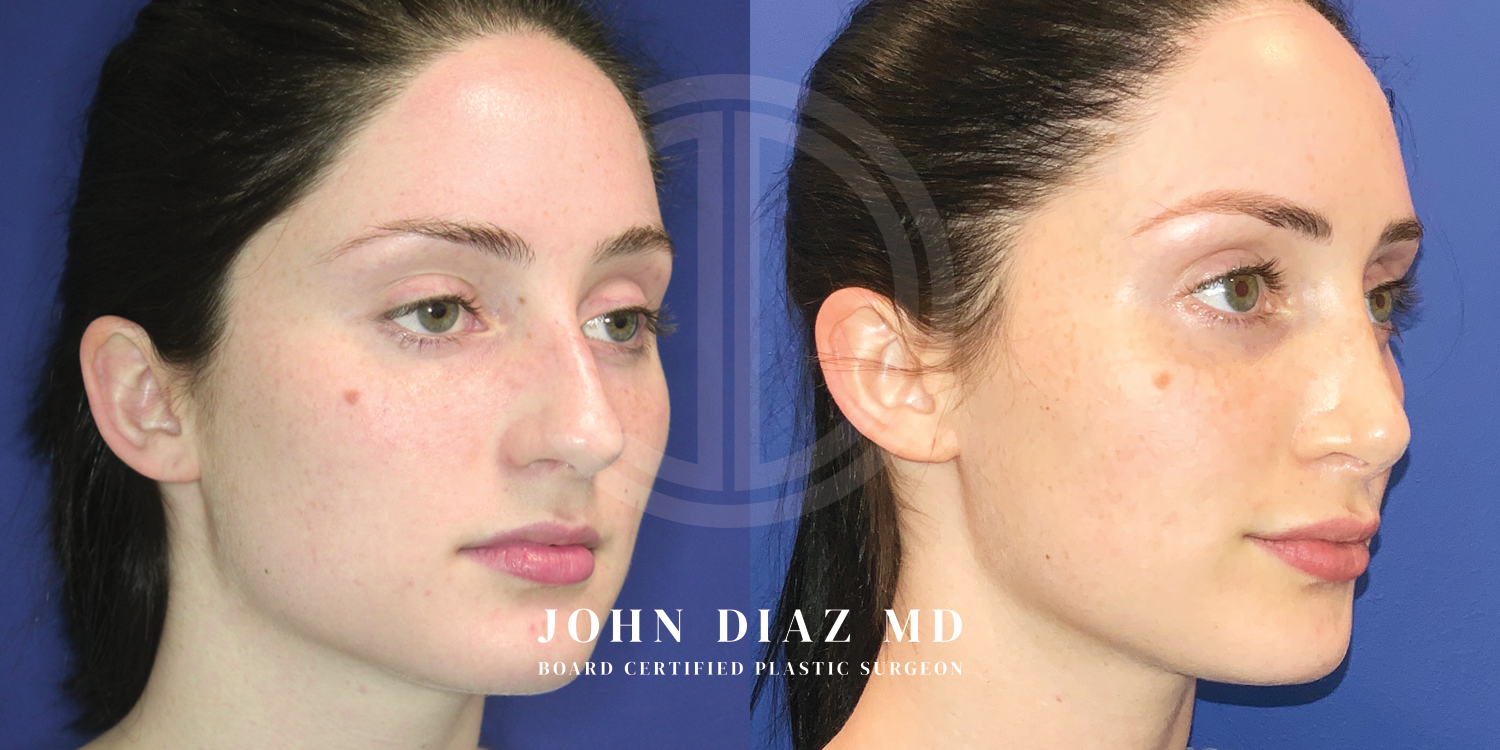 Dr John Diaz Before and After | Rhinoplasty