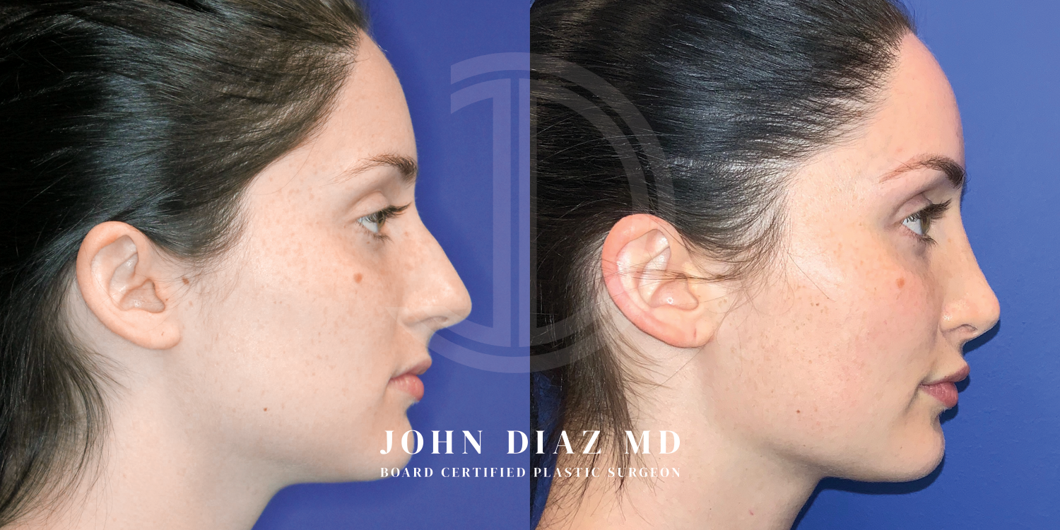 Dr John Diaz Before and After | Rhinoplasty
