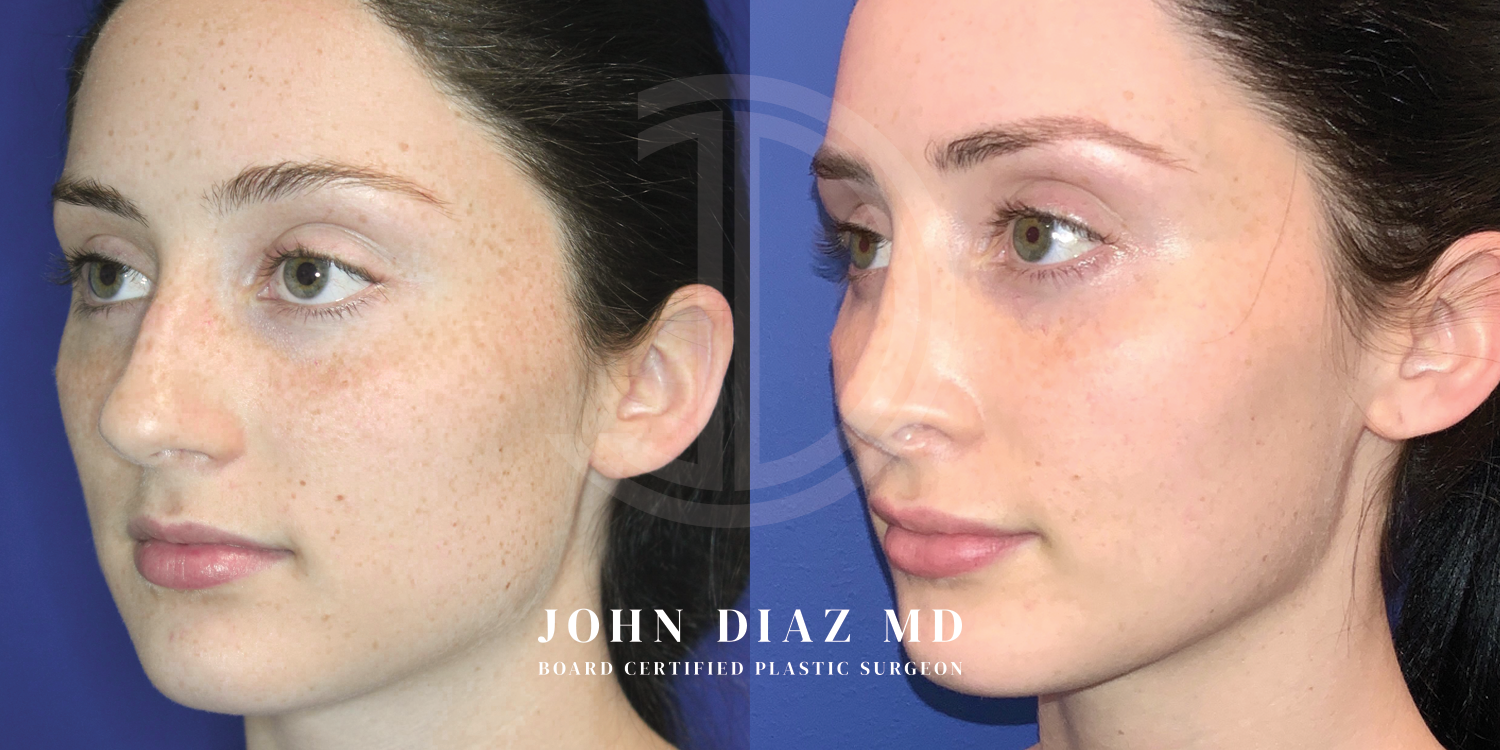 Dr John Diaz Before and After | Rhinoplasty