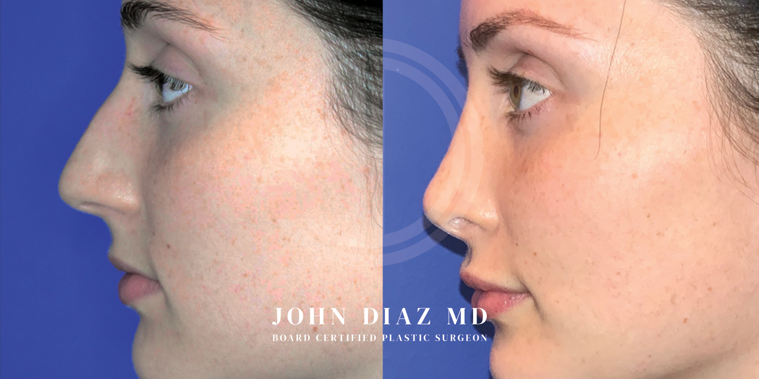 Dr John Diaz Before and After | Rhinoplasty