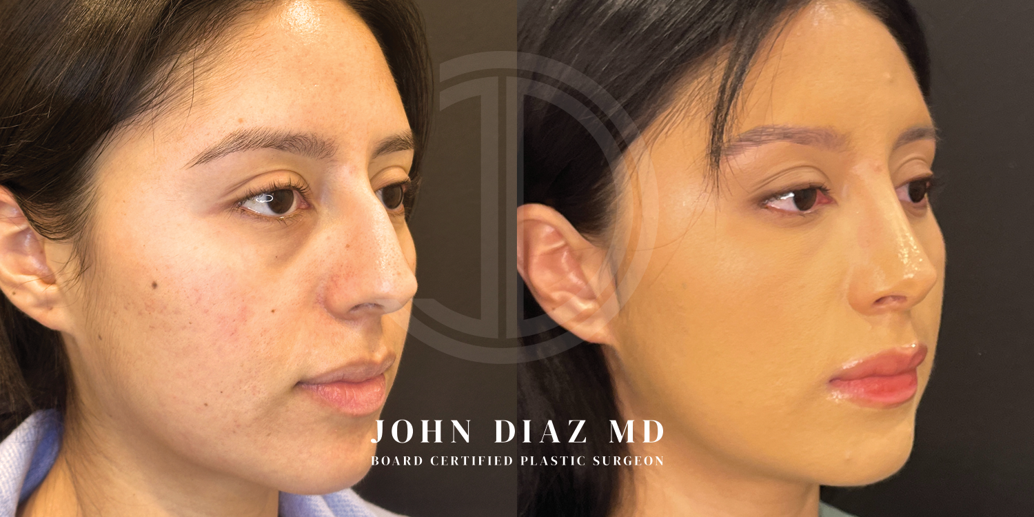 Dr John Diaz Before and After | Rhinoplasty