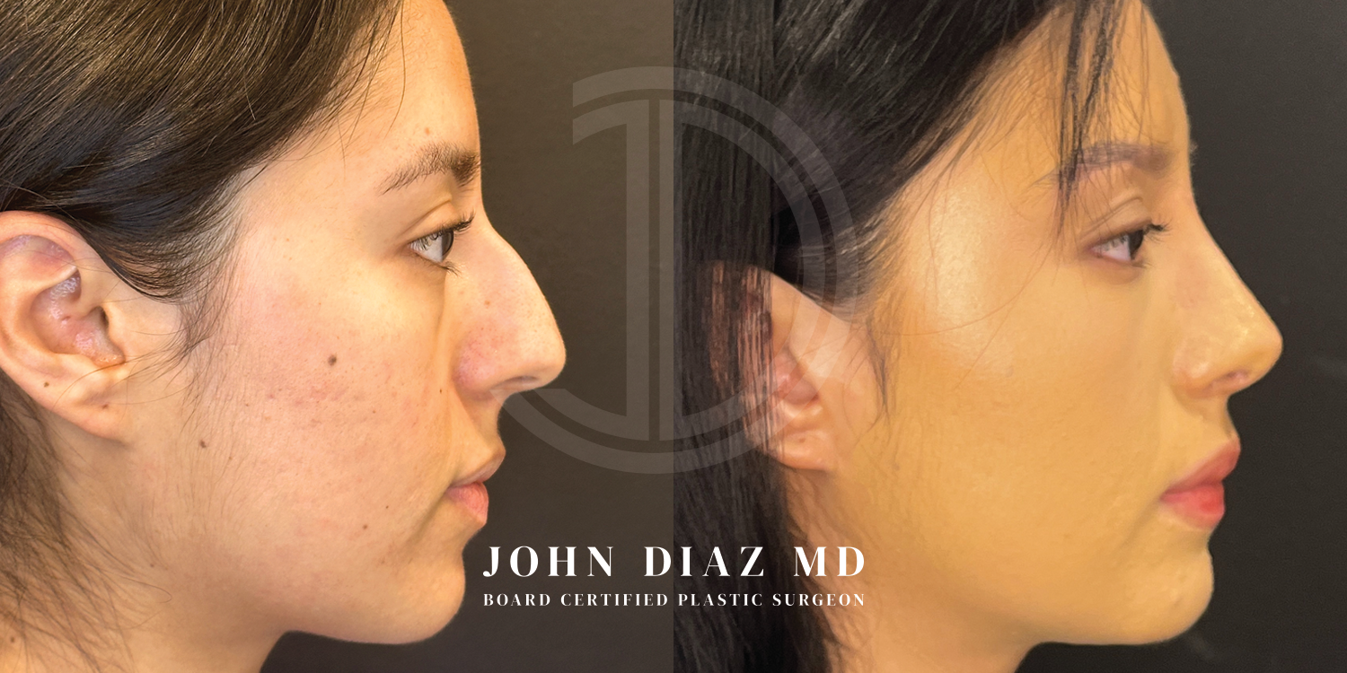 Dr John Diaz Before and After | Rhinoplasty