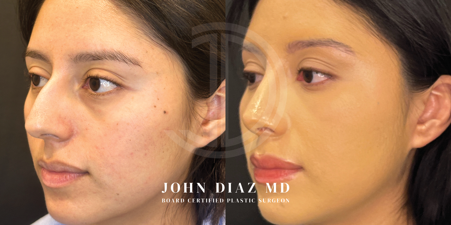 Dr John Diaz Before and After | Rhinoplasty