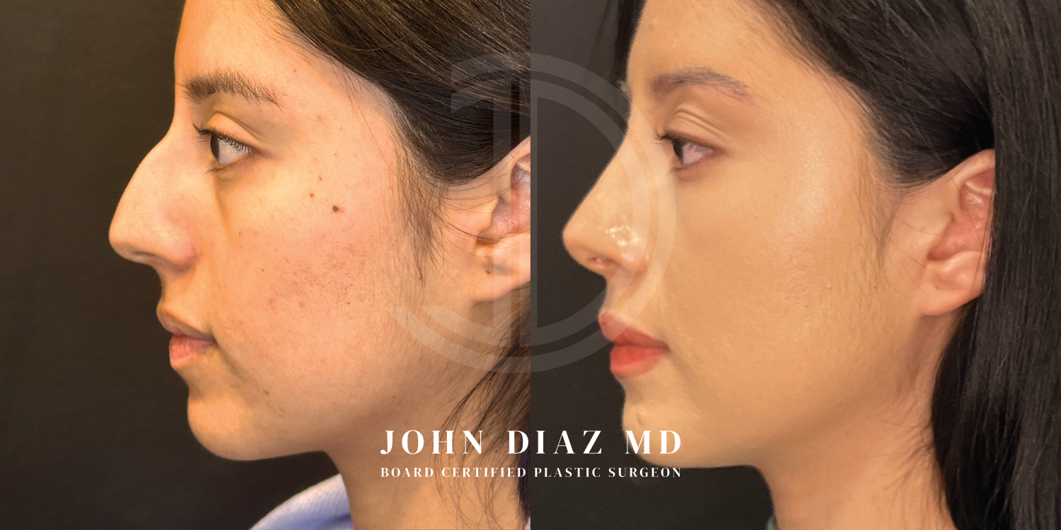 Dr John Diaz Before and After | Rhinoplasty