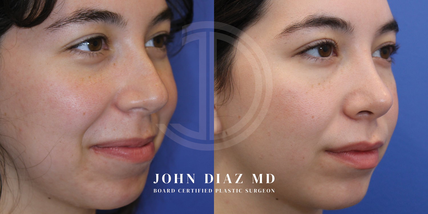 Dr John Diaz Before and After | Rhinoplasty