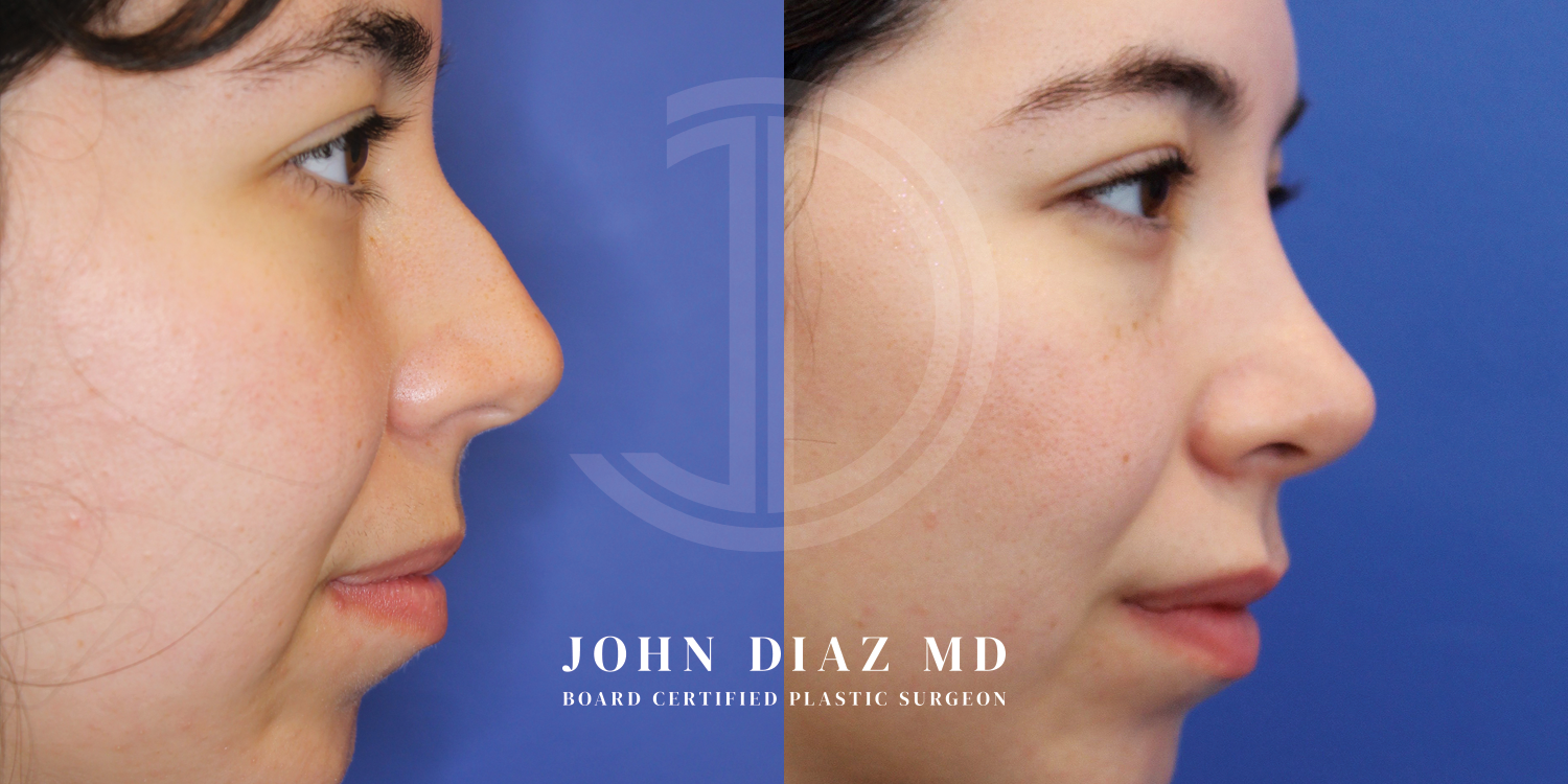 Dr John Diaz Before and After | Rhinoplasty