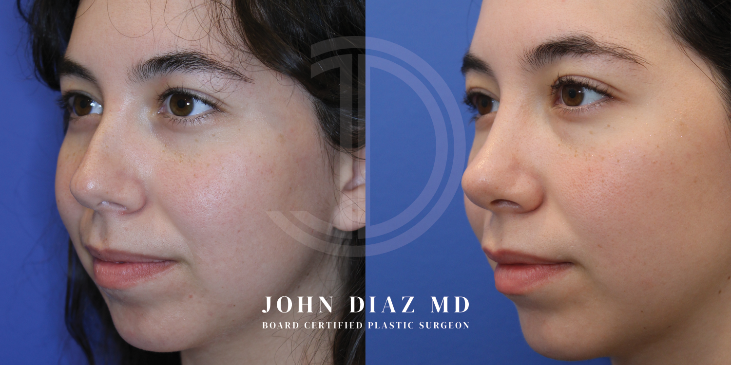 Dr John Diaz Before and After | Rhinoplasty