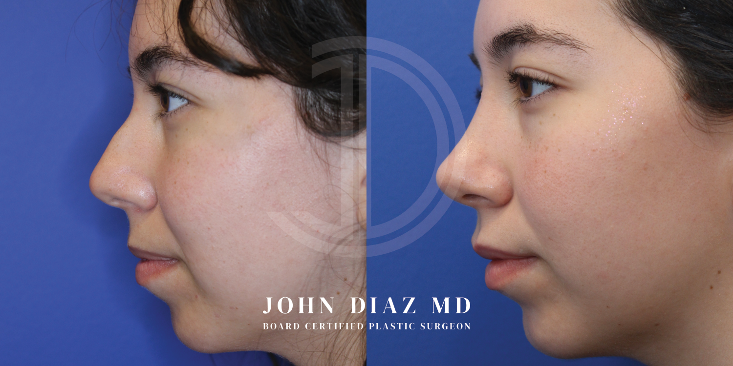 Dr John Diaz Before and After | Rhinoplasty