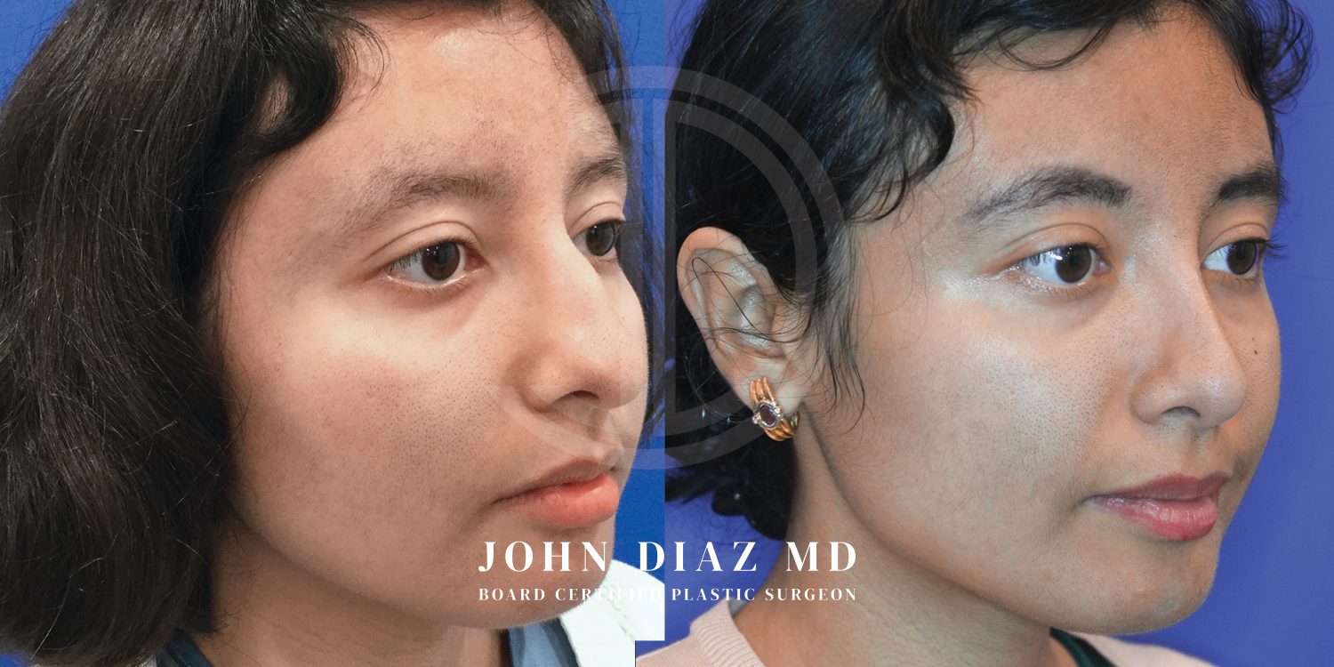 Dr John Diaz Before and After | Rhinoplasty