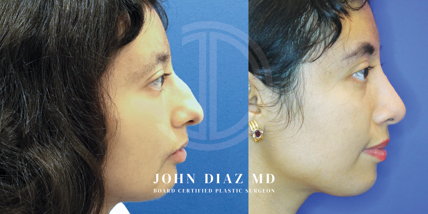 Dr John Diaz Before and After | Rhinoplasty
