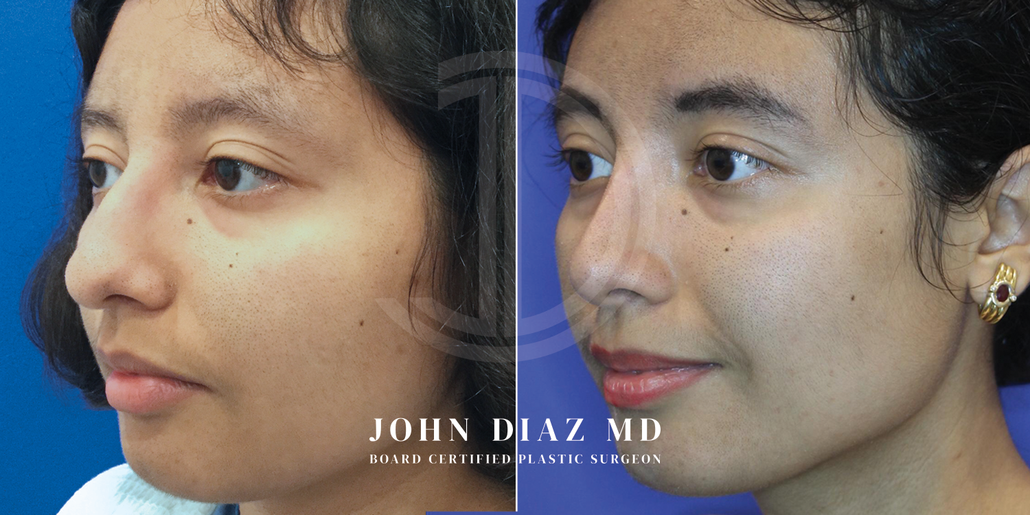 Dr John Diaz Before and After | Rhinoplasty