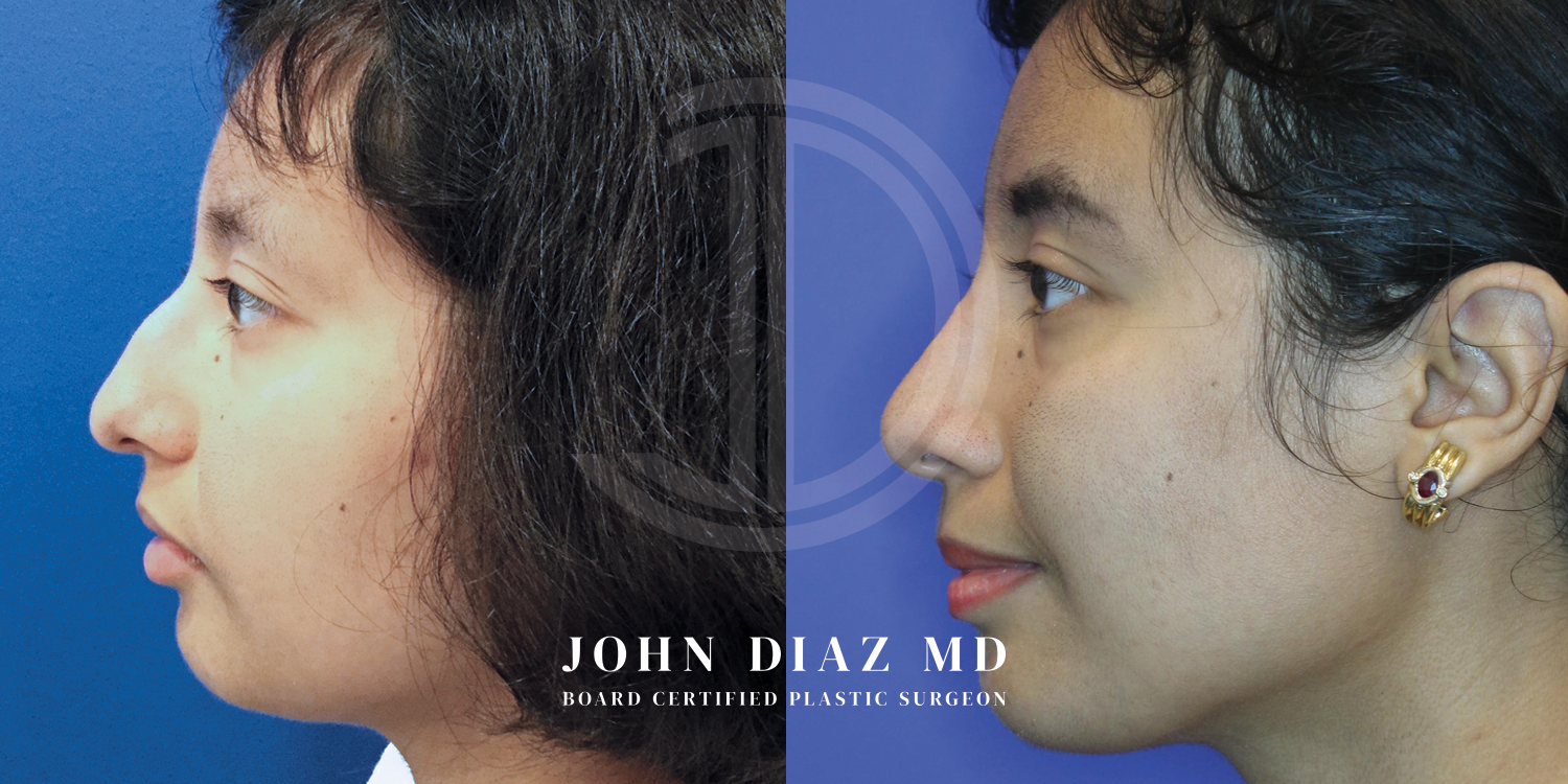 Dr John Diaz Before and After | Rhinoplasty
