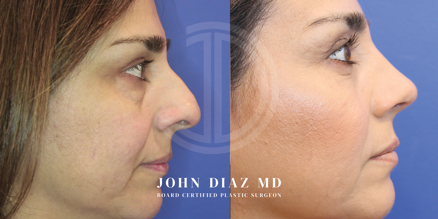 Dr John Diaz Before and After | Rhinoplasty
