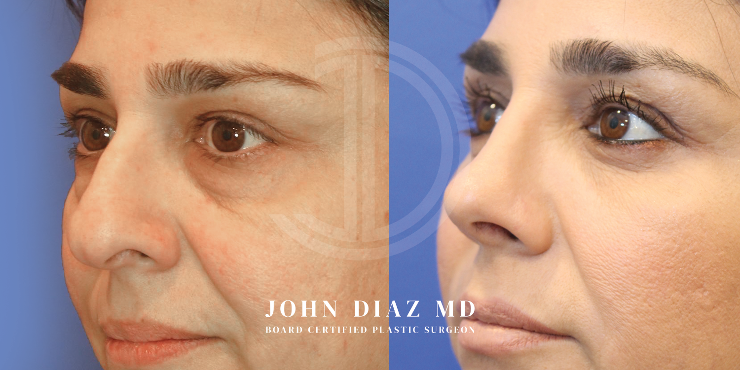 Dr John Diaz Before and After | Rhinoplasty