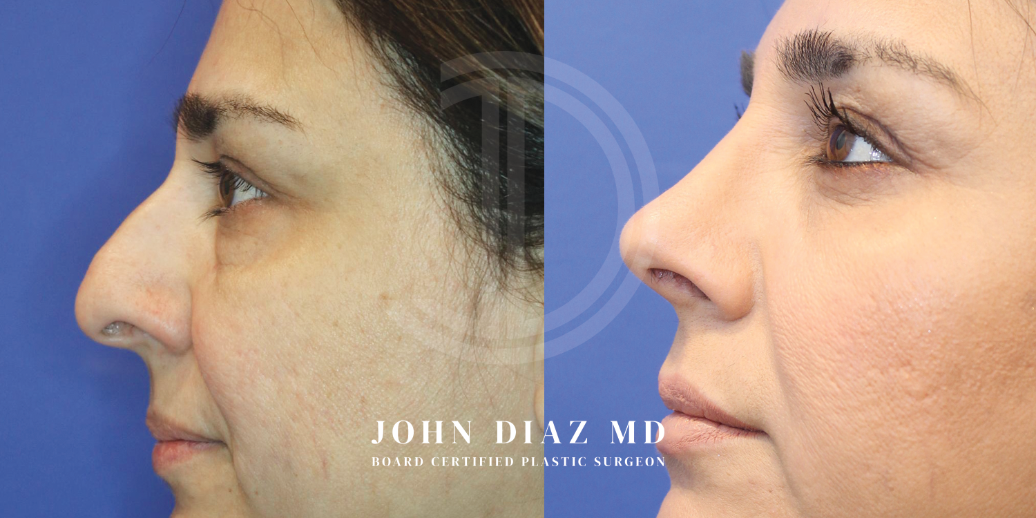 Dr John Diaz Before and After | Rhinoplasty