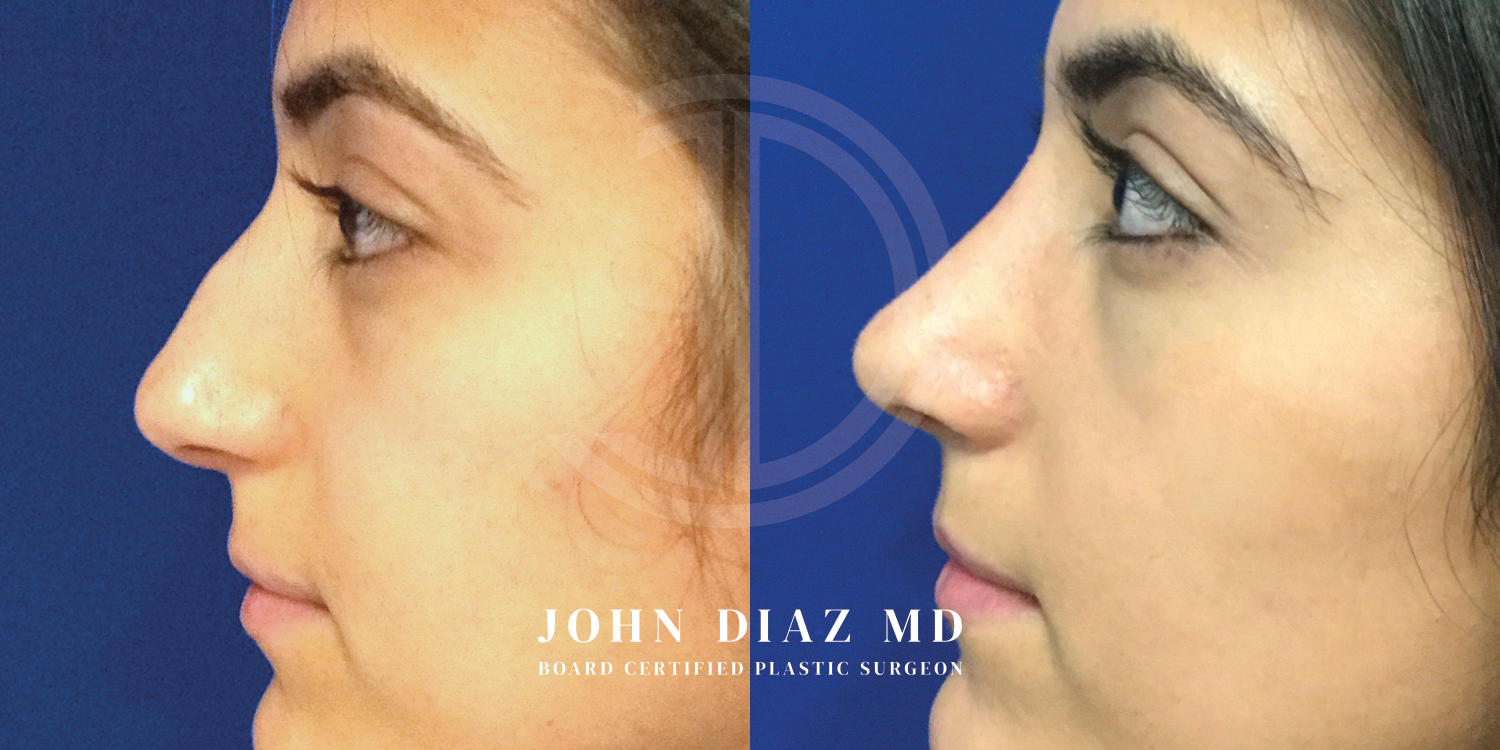 Dr John Diaz Before and After | Rhinoplasty