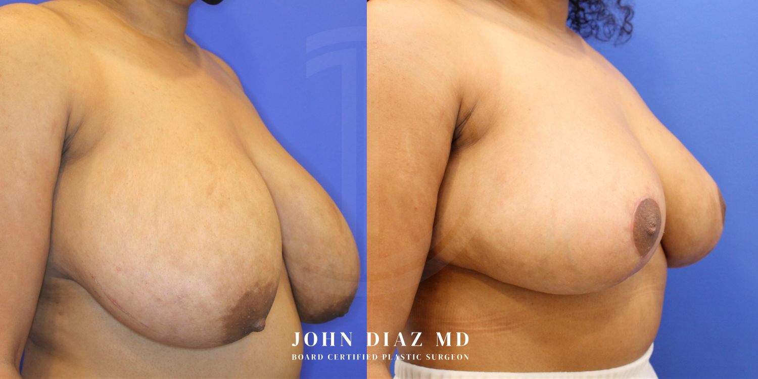 Dr John Diaz Before and After | Breast Augmentation
