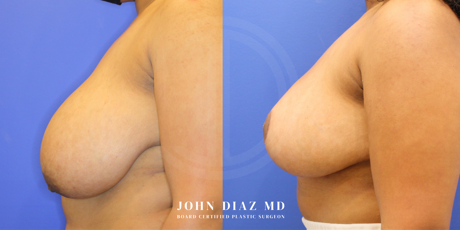 Dr John Diaz Before and After | Breast Augmentation