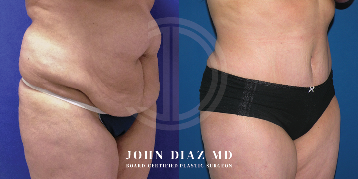 Dr John Diaz Before and After | Tummy Tuck