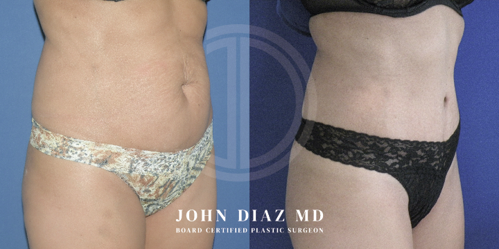 Dr John Diaz Before and After | Tummy Tuck