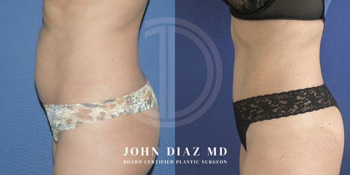 Dr John Diaz Before and After | Tummy Tuck