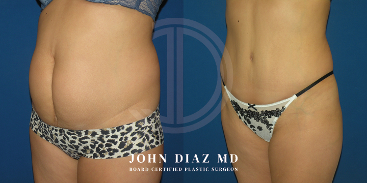 Dr John Diaz Before and After | Tummy Tuck