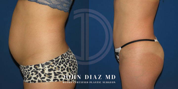 Dr John Diaz Before and After | Tummy Tuck