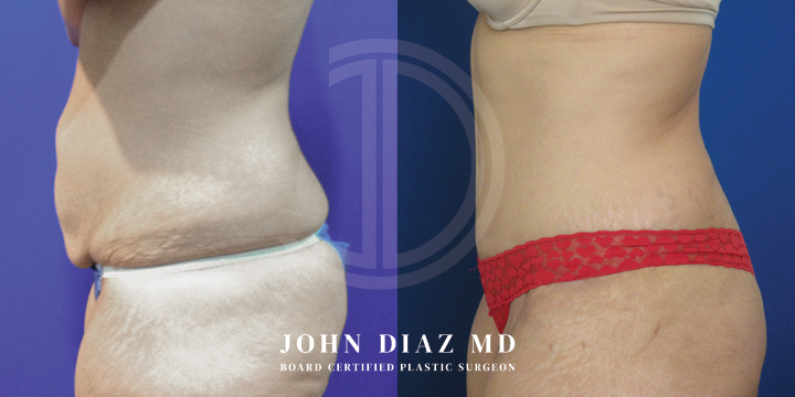 Dr John Diaz Before and After | Tummy Tuck