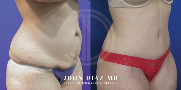 Dr John Diaz Before and After | Tummy Tuck